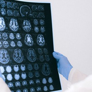 Alzheimer-Krankheit – was ist sie wirklich und kann sie geheilt werden?