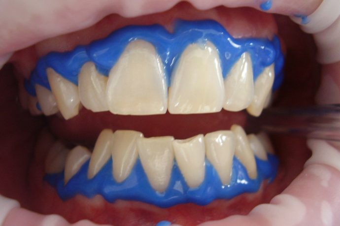 Ist das kosmetische Bleaching von Zähnen schädlich?
